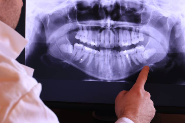 Best Emergency Tooth Extraction in Central City, IL