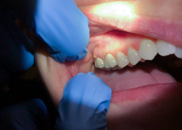 Best Emergency Denture Repair in Central City, IL
